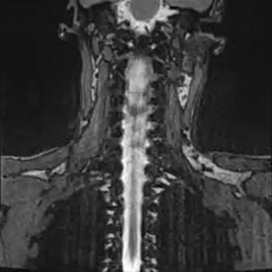 MRI Spine Myelography